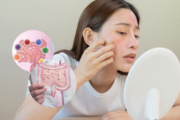 Sensitive Skin & Eczema: How Probiotics Can Help Restore Balance from Within
