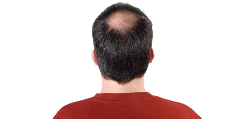 Hair Loss | How to Solve Hair Loss Problems? - Baizigui