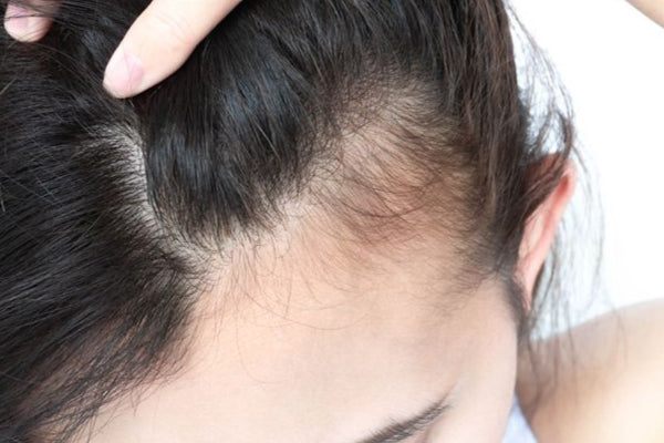 Is Baldness Hereditary? How to Prevent Hair Loss in the Next Generation