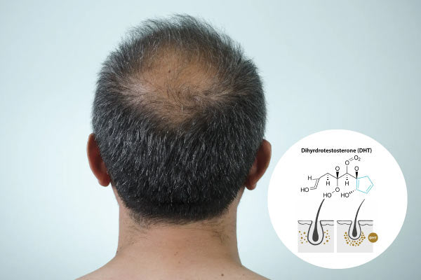 The Hidden Driver Behind Your Receding Hairline: The Link Between Male Baldness and DHT