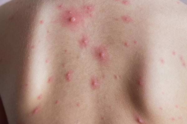 Can Probiotics Really Help with Back Acne and Skin Sensitivity? A Scientific Breakdown