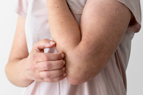 Alcohol Rash vs Urticaria: What Sensitive Skin Needs to Know