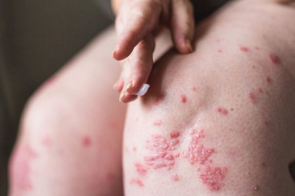 Understanding Sensitive Skin and the Science of Nano-Herbal Repair