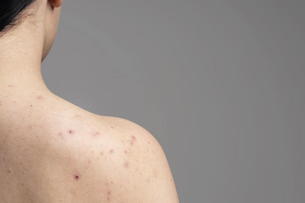 Recurring Skin Sensitivity? Your "Gut-Skin Axis" Might Need a Deep Cleanse