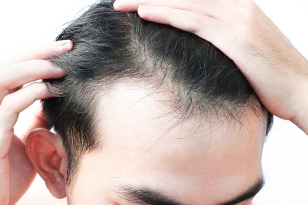 Saving Your Hairline & Hair Loss : Why Your Scalp Needs a Herbal Detox