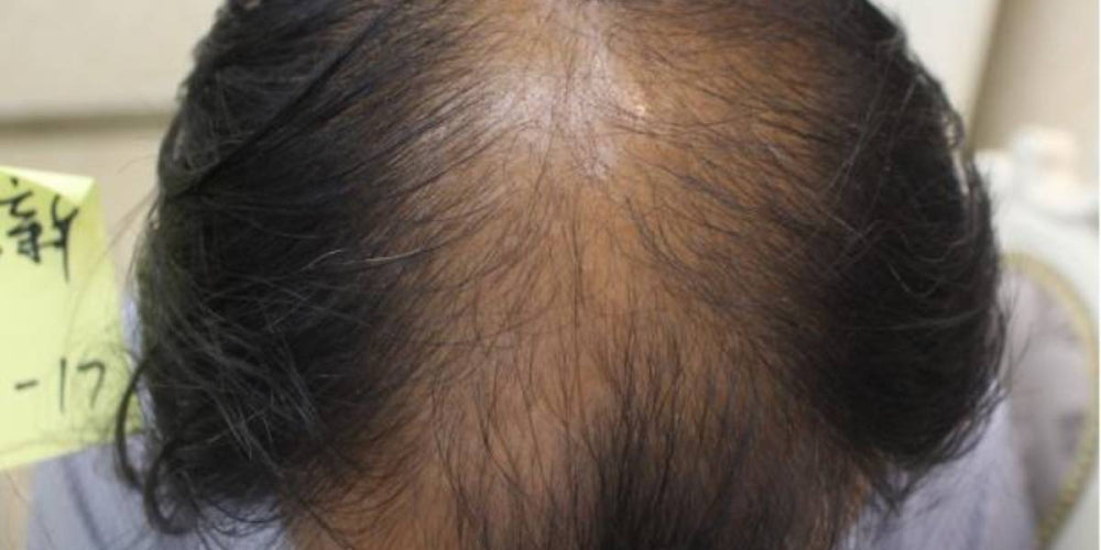 10 Key Factors to Prevent Hair Loss! | Necessary for Hair Growth!