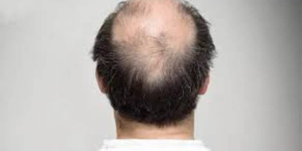 Understanding the Difference Between Hair Loss and Normal Hair Shedding