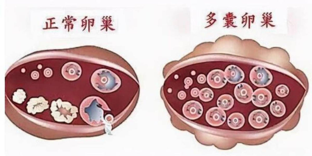 Strategies for PCOS Patients to Achieve Pregnancy