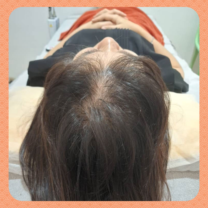 Before - From Widening Parting Line to New Growth: My Real Hair Recovery Journey