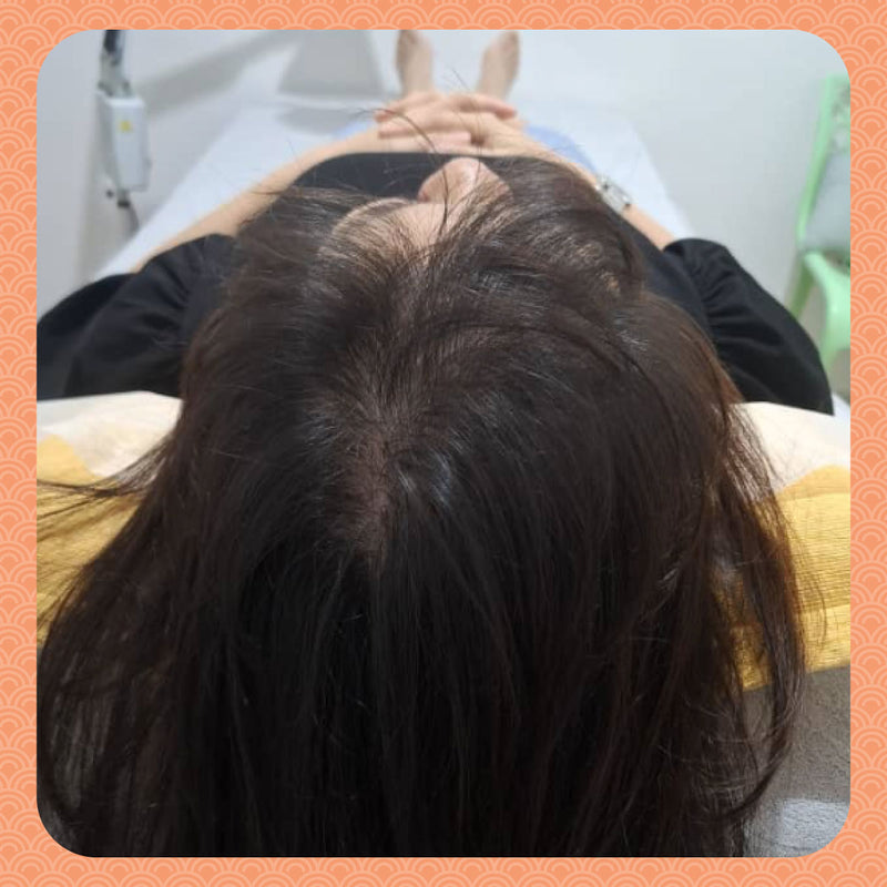 After - From Widening Parting Line to New Growth: My Real Hair Recovery Journey
