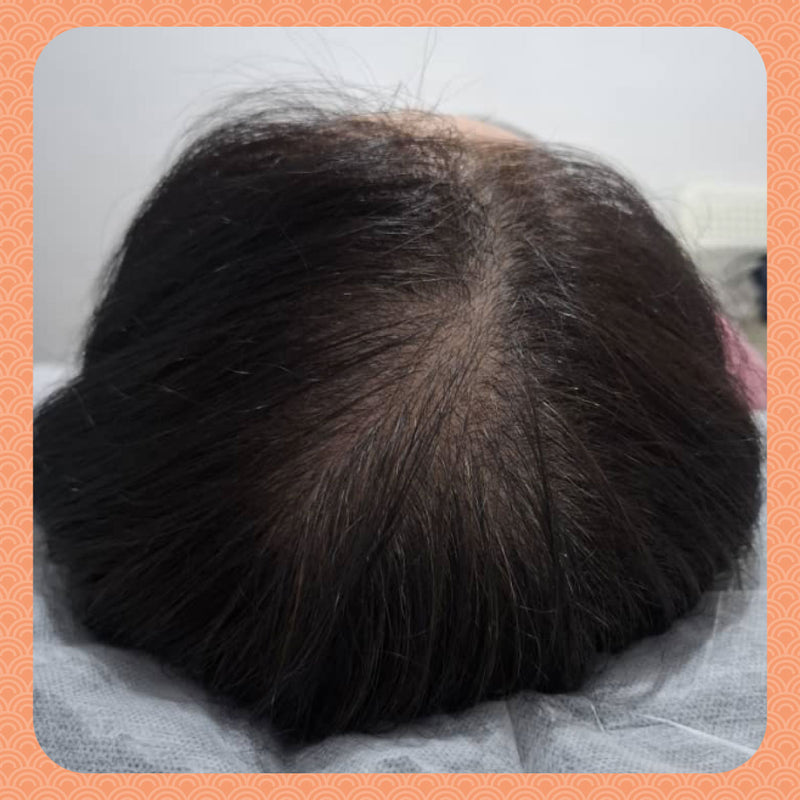 Before - From Widening Parting Line to Full Volume: Ms. Y’s 3-Month Hair Revival