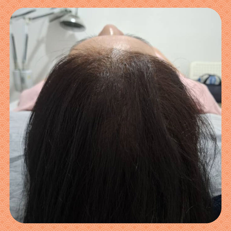 After - From Widening Parting Line to Full Volume: Ms. Y’s 3-Month Hair Revival
