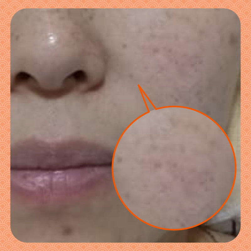 Before - Faded Freckles in Just 2 Sessions! The Power of Natural TCM Beauty