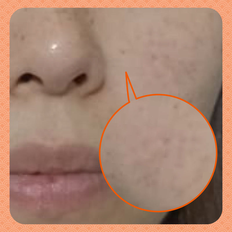 After - Faded Freckles in Just 2 Sessions! The Power of Natural TCM Beauty