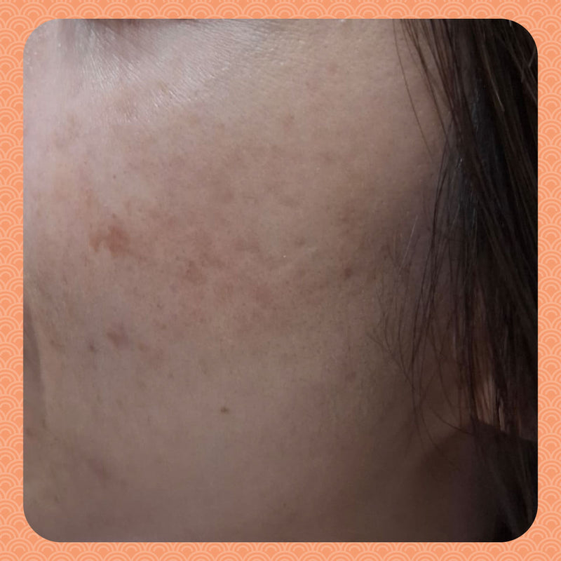 Before - Ditching the Creams: How Ms. K Brightened Her Complexion a Whole Shade Lighter