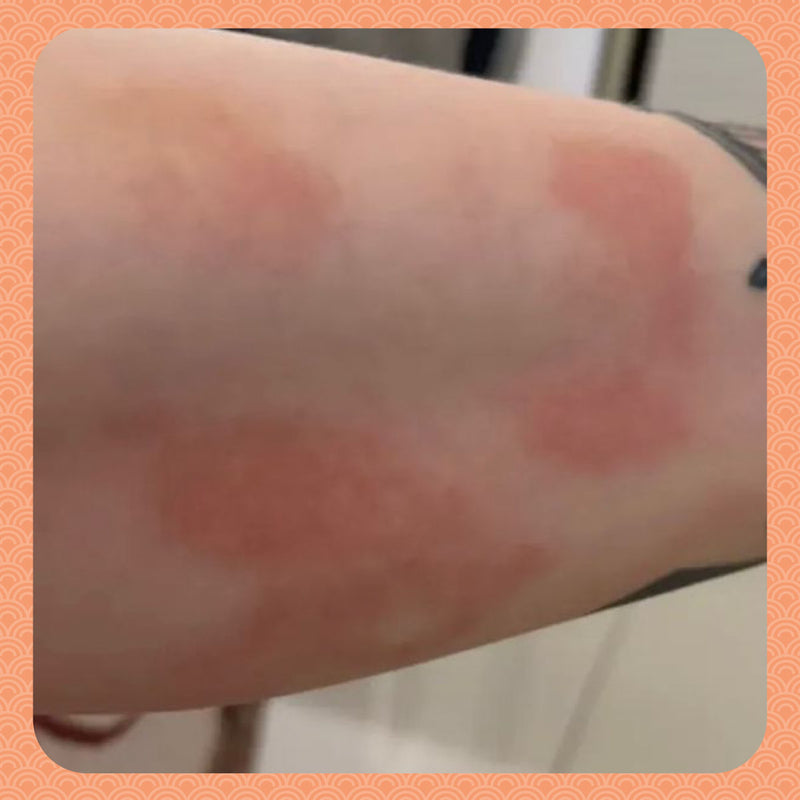 Before - Clear Skin in 1 Week: How Rebalancing My Body Stopped My Eczema Flare-Ups