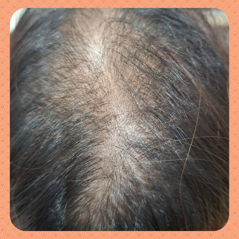 Before - Fixing the Root Cause: How I Stopped My Thinning Hair by Rebalancing My Qi and Blood