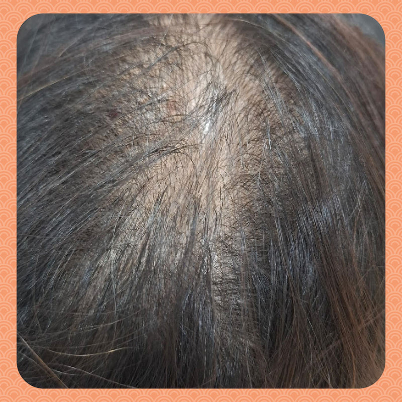 After - Fixing the Root Cause: How I Stopped My Thinning Hair by Rebalancing My Qi and Blood