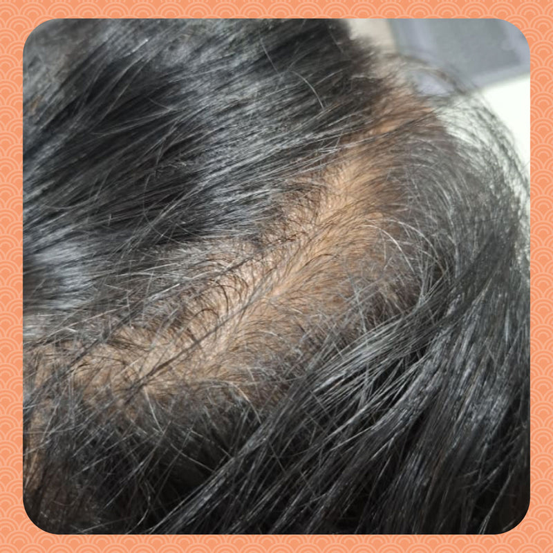 Before - Sessions to a Narrower Parting Line: How I Woke Up My Dormant Hair Follicles