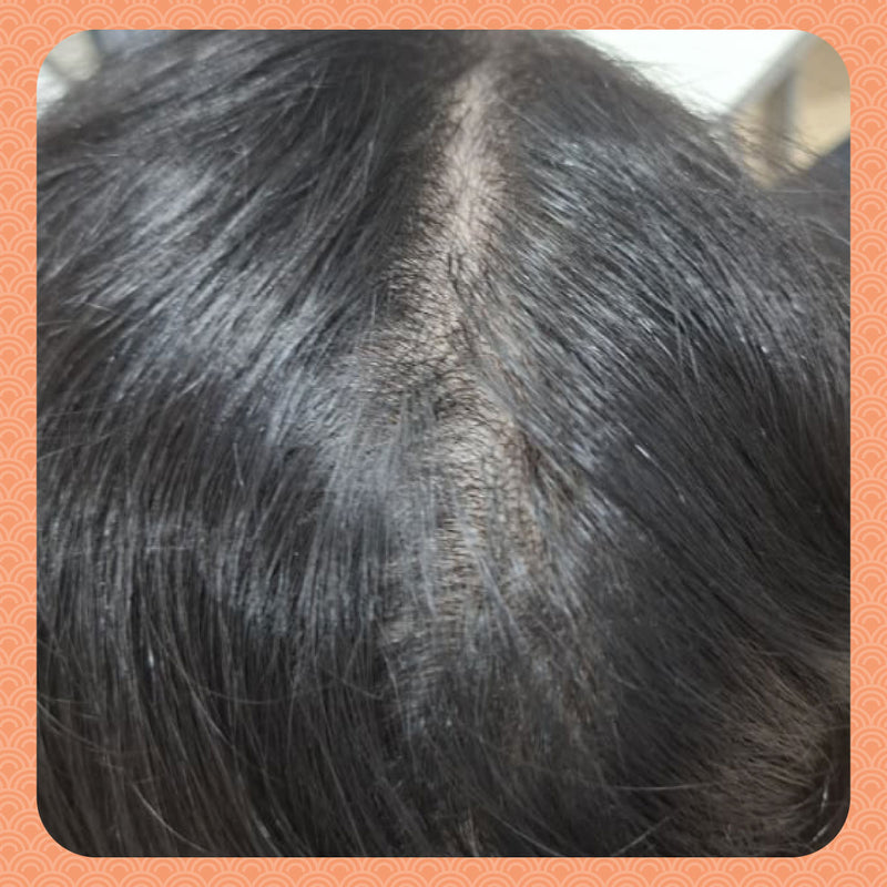 After - Sessions to a Narrower Parting Line: How I Woke Up My Dormant Hair Follicles